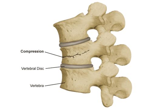 Vertebral Compression Fracture | Risk Factors & Treatment