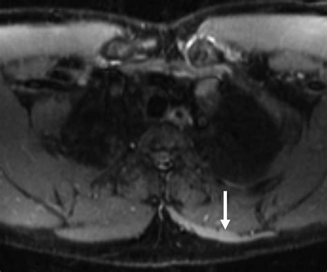 Mri Findings Of Spinal Accessory Neuropathy Clinical Radiology