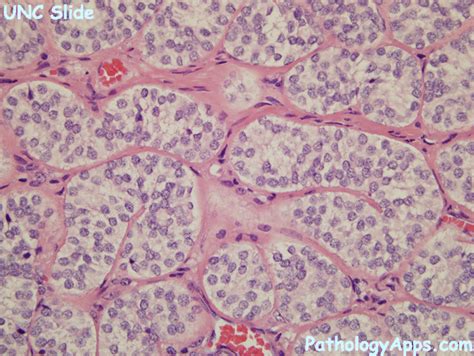 Sertoli Cell Tumor Pathology