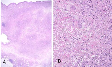 Necrobiotic Xanthogranuloma Histology