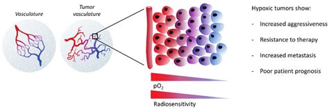 Tumor Microenvironment And Hypoxia The Majority Of Solid Tumors Are