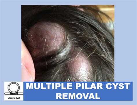 Pilar Cysts What Are Multiple Pilar Cysts And How To Remove Them