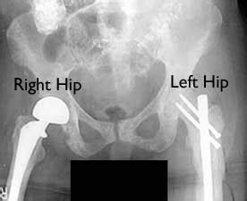 Medical Treatment Pictures-for Better Understanding: Partial Hip ...