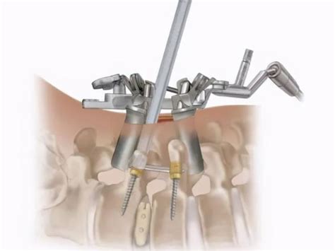 脊柱微創手術 這些你都知道了嗎？ 每日頭條