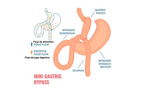 Mini Gastric Bypass Obesity Not 4 Me