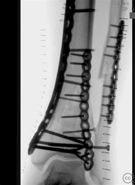 Aoota 43 C3 Pilon Fracture Through A Posterolateral Approach