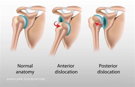 Dislocating Shoulder Schaumburg Thomas Obermeyer Md