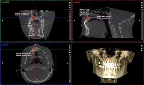 Cbct Image Showing The Measurement Of Defect Volume And Bone Density