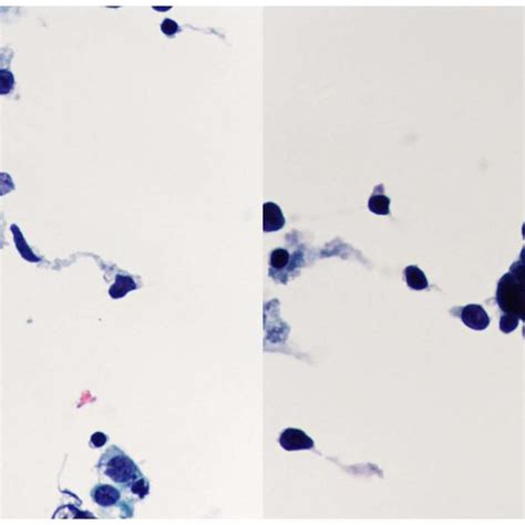 Cytomorphology Of Lung Adenocarcinoma Adc In Thinprep Bronchial