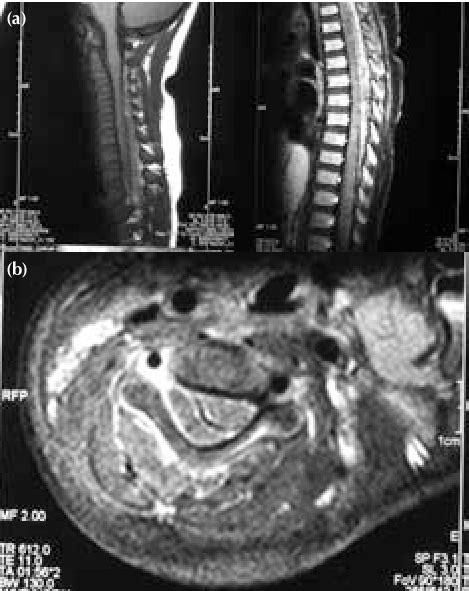 A Sagittal T1 Weighted Magnetic Resonance Images Showing An Extensive