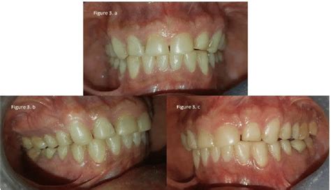 Composite veneer restorations of labial/buccal surfaces to restore ...