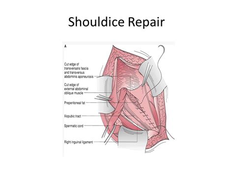 Inguinal Hernia Repair Shouldice