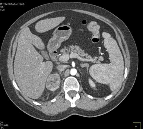 Acute And Chronic Pyelonephritis Right Kidney Kidney Case Studies