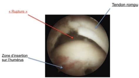 La rupture de la coiffe des rotateurs Clinique de l épaule du coude
