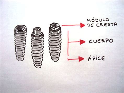 4 3 Tipos Y Partes Principales De Un Implante Dental P002 Contenidos