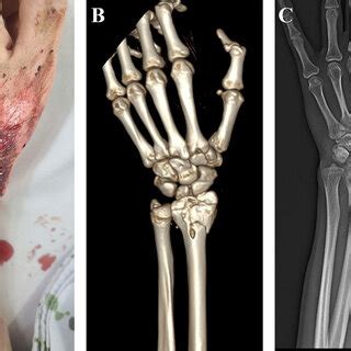 A-54-year-old woman with degloving injury in her left lower leg. A... | Download Scientific Diagram