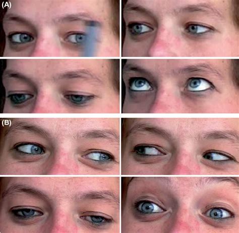 Superior Gaze Palsy