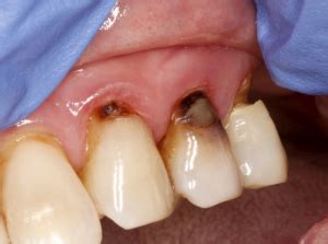 Tooth Decay on the Root Surface | MCCarl Dental Group