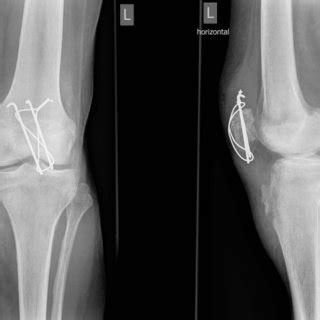 Anteroposterior And Lateral Radiographs Of Left Knee Showing The