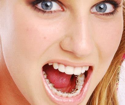 Pros Cons Of Lingual Braces Braces Behind The Teeth