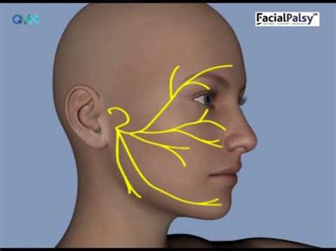 Facial Nerve Palsy