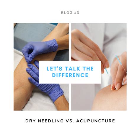 Let S Talk The Difference Dry Needling Vs Acupuncture KCP Physical