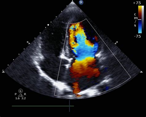 Causes And Risks Of Low Amniotic Fluid Facty Health