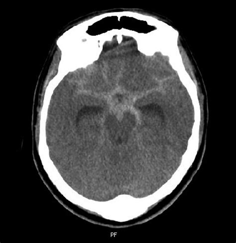 Infected Bilateral Chylothorax in a Problematic Case | Bakar | Journal ...