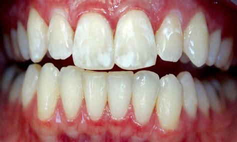 Do Orthodontic Braces Cause White Spots On Teeth Directorio Odontológico