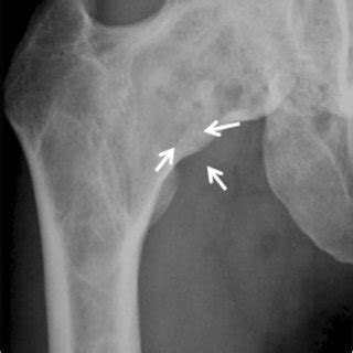 Pdf Surgical Treatment For Fibrous Dysplasia Of Femoral Neck With