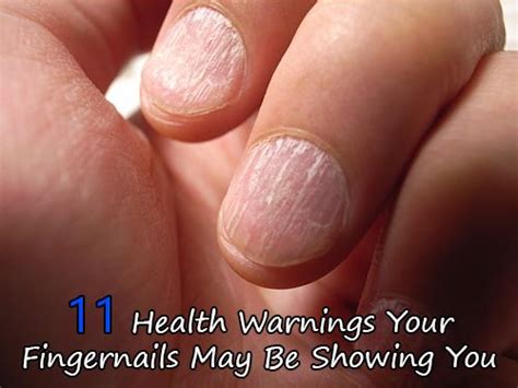 11 Health Warnings Your Fingernails May Be Showing You Nail Problems