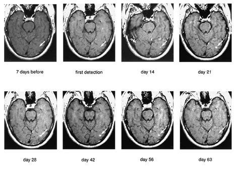 Duration Of Contrast Enhancement In A New Multiple Sclerosis Lesion