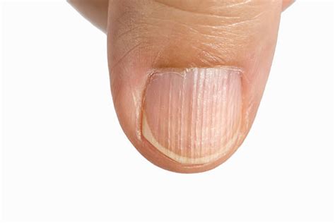 Uñas Enfermas - Banco de fotos e imágenes de stock - iStock
