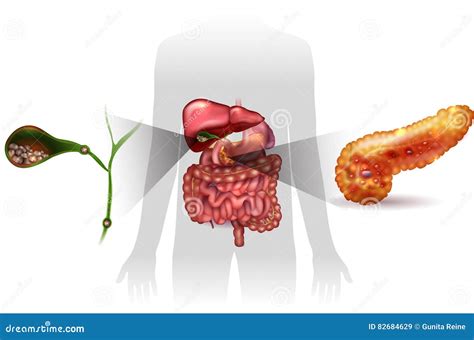 Gallstones, pancreatitis stock vector. Illustration of acute - 82684629