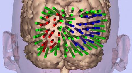 Visual cortex mapping showing stimulation points color-coded by visual ...