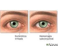 Usando Lentillas Para Ojos Rojos Financial Red