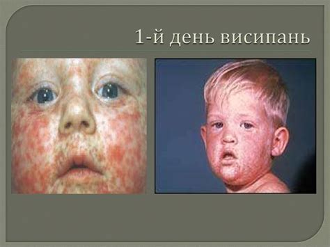 Кір. Краснуха - презентация онлайн