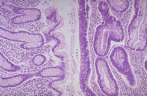 Tubular Adenoma Histology