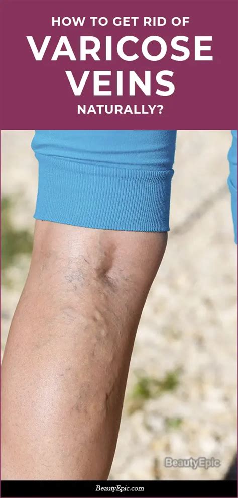 How To Get Rid Of Varicose Veins Naturally In 2025