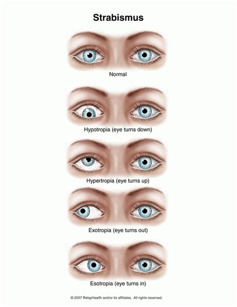 Strabismus - Pediatric Eye Disease Investigator Group