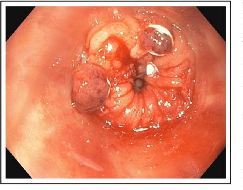 Figure 1 From Rubber Band Ligation Of Hemorrhoids Is Often A Necessary Complement In The