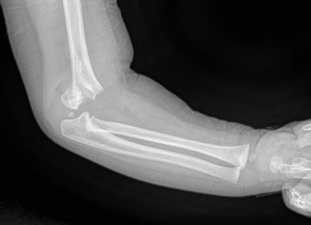 Supracondylar Fracture Radiology Case Radiopaedia Org