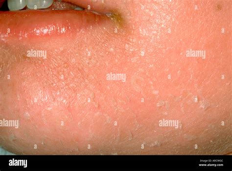 Toxic Shock Rash Hi Res Stock Photography And Images Alamy