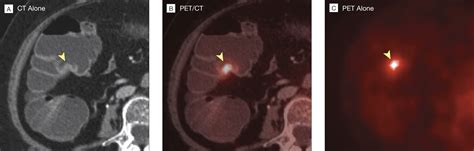 Diagnostic Accuracy Of Colorectal Cancer Staging With Whole Body PET CT