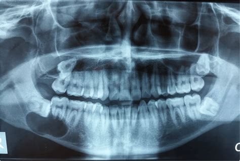 Panoramic View Shows A Well Demarcated Unilocular Radiolucency In Right