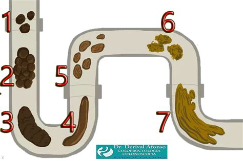 Aspecto Das Fezes Forma Cor E Cheiro COLONOSCOPIA COLOPROCTOLOGIA