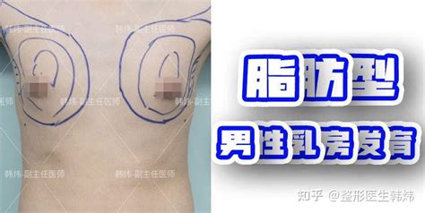 注意这些习惯可能导致男性乳房发育 知乎