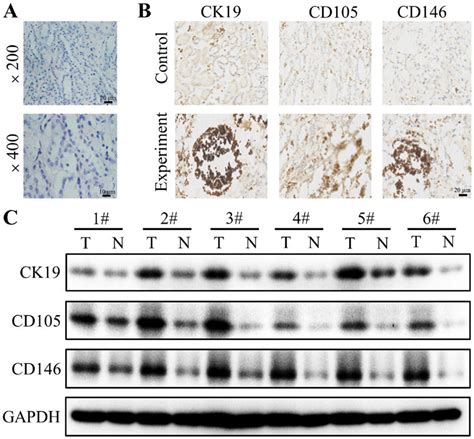 Ck Cd And Cd Expression In Renal Cell Carcinoma Tissues A