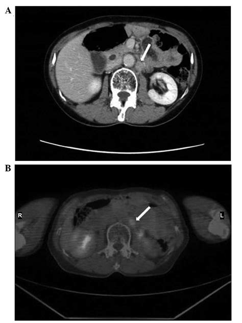 Ct Scan Lymph Nodes