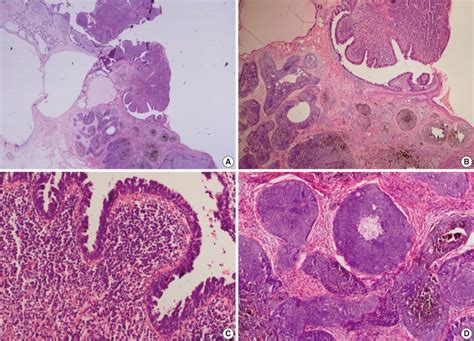 Syringocystadenoma Papilliferum In The Superficial Part Of The Lesion